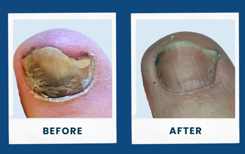 Before and After ToeFX